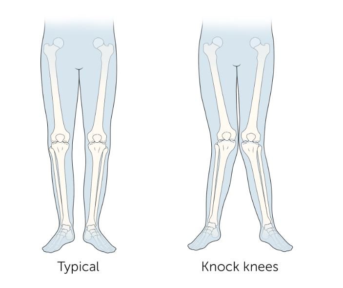 Knock Knees